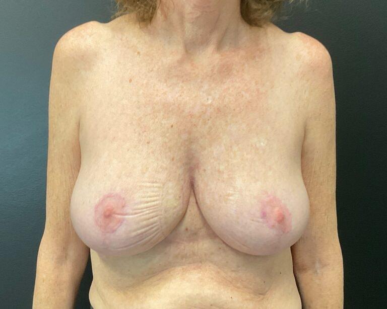 Jeremy Williams, MD breast lift after — Lone Tree, CO