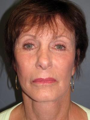 Pacific Center for Plastic Surgery after — Newport Beach, CA