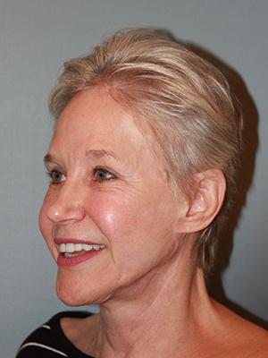 Pacific Center for Plastic Surgery after — Newport Beach, CA