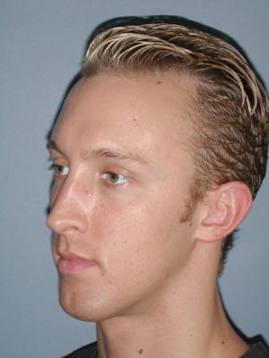 Rhinoplasty after at Pacific Center for Plastic Surgery in Newport Beach, CA