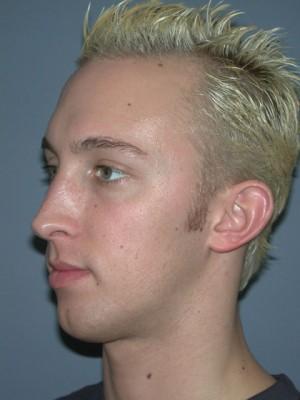 Rhinoplasty before at Pacific Center for Plastic Surgery in Newport Beach, CA
