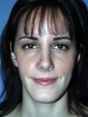 Rhinoplasty after at Pacific Center for Plastic Surgery in Newport Beach, CA