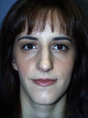 Rhinoplasty before at Pacific Center for Plastic Surgery in Newport Beach, CA