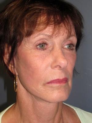Pacific Center for Plastic Surgery after — Newport Beach, CA