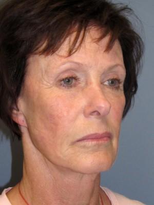 Mini Facelift before at Pacific Center for Plastic Surgery in Newport Beach, CA
