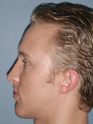 Rhinoplasty after at Pacific Center for Plastic Surgery in Newport Beach, CA