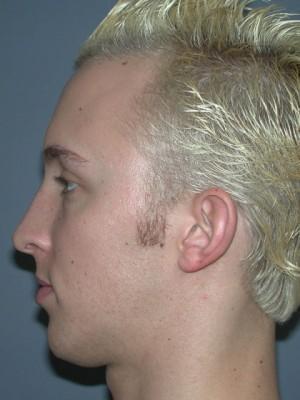 Rhinoplasty before at Pacific Center for Plastic Surgery in Newport Beach, CA