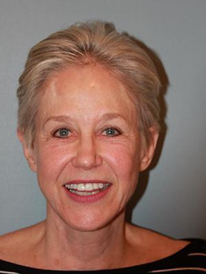 Pacific Center for Plastic Surgery facelift after — Newport Beach, CA