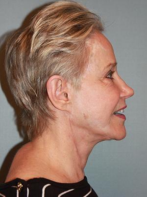 Pacific Center for Plastic Surgery after — Newport Beach, CA