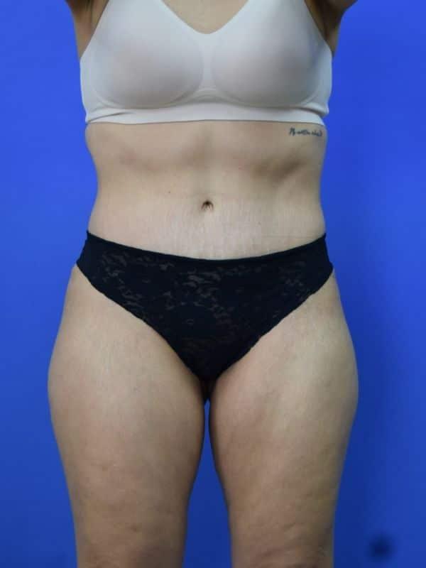 Glamour Plastic Surgery and Med Spa tummy tuck after — Bellaire, TX