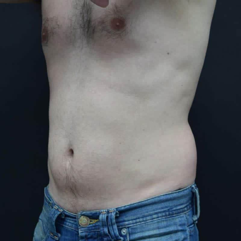 Glamour Plastic Surgery and Med Spa emsculpt after — Bellaire, TX