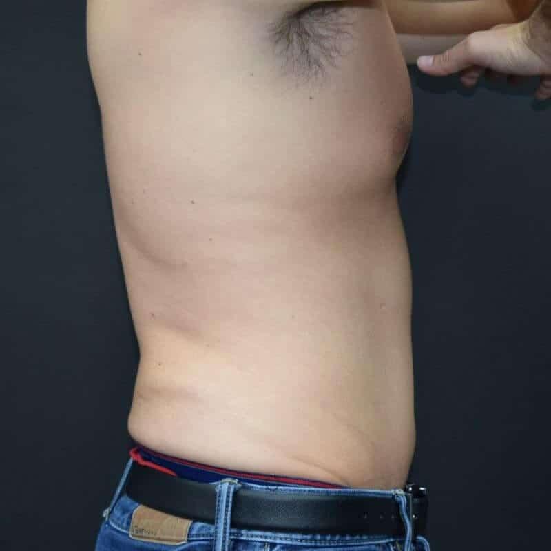 Glamour Plastic Surgery and Med Spa emsculpt after — Bellaire, TX