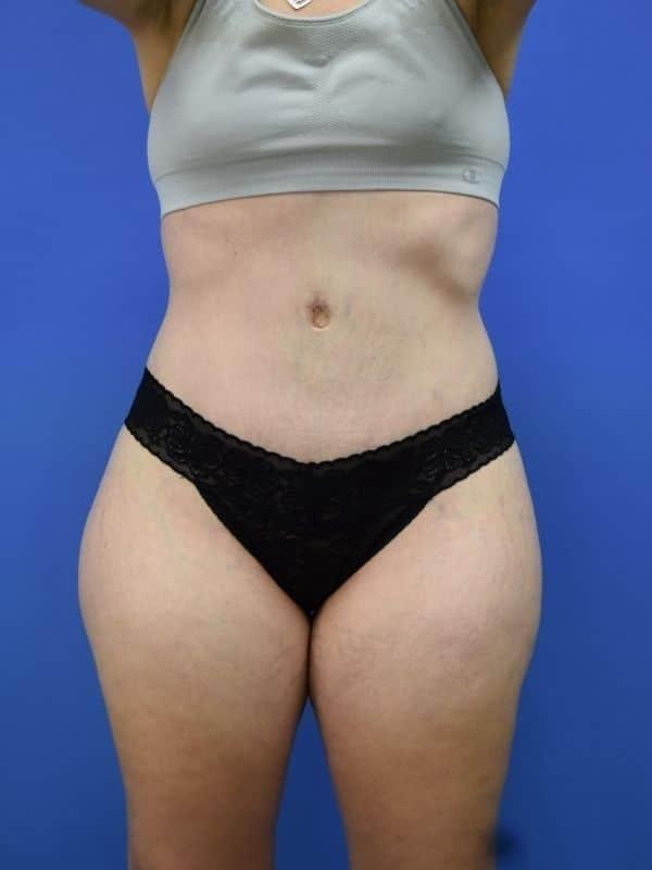 Glamour Plastic Surgery and Med Spa tummy tuck after — Bellaire, TX