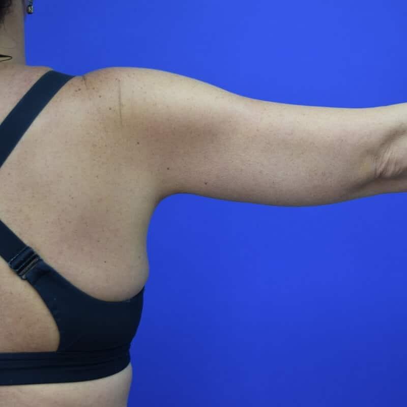 Glamour Plastic Surgery and Med Spa arm lift after — Bellaire, TX