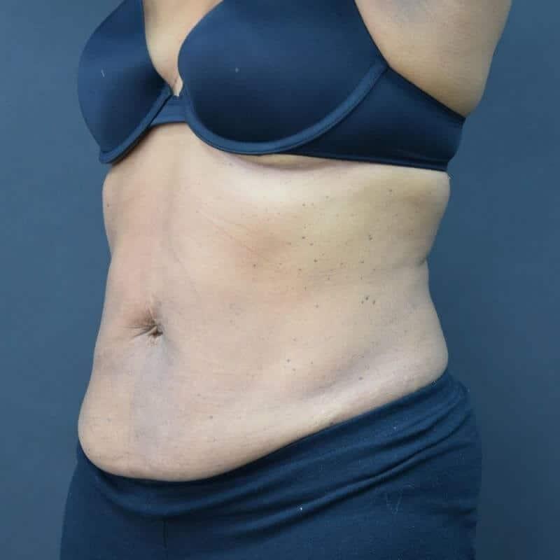 Glamour Plastic Surgery and Med Spa emsculpt after — Bellaire, TX