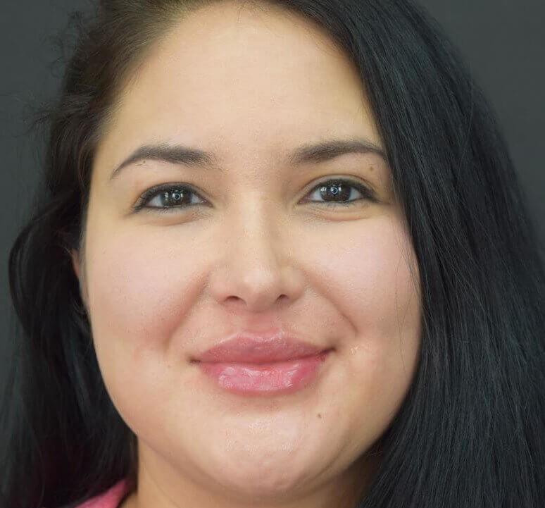 Glamour Plastic Surgery and Med Spa lip filler after — Bellaire, TX