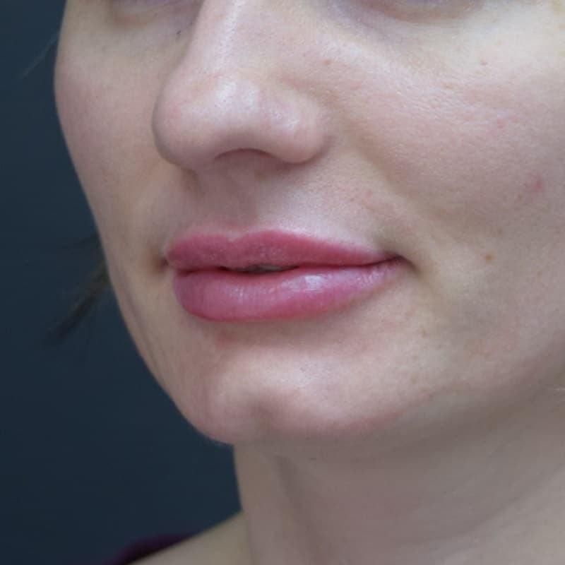 Glamour Plastic Surgery and Med Spa lip filler after — Bellaire, TX