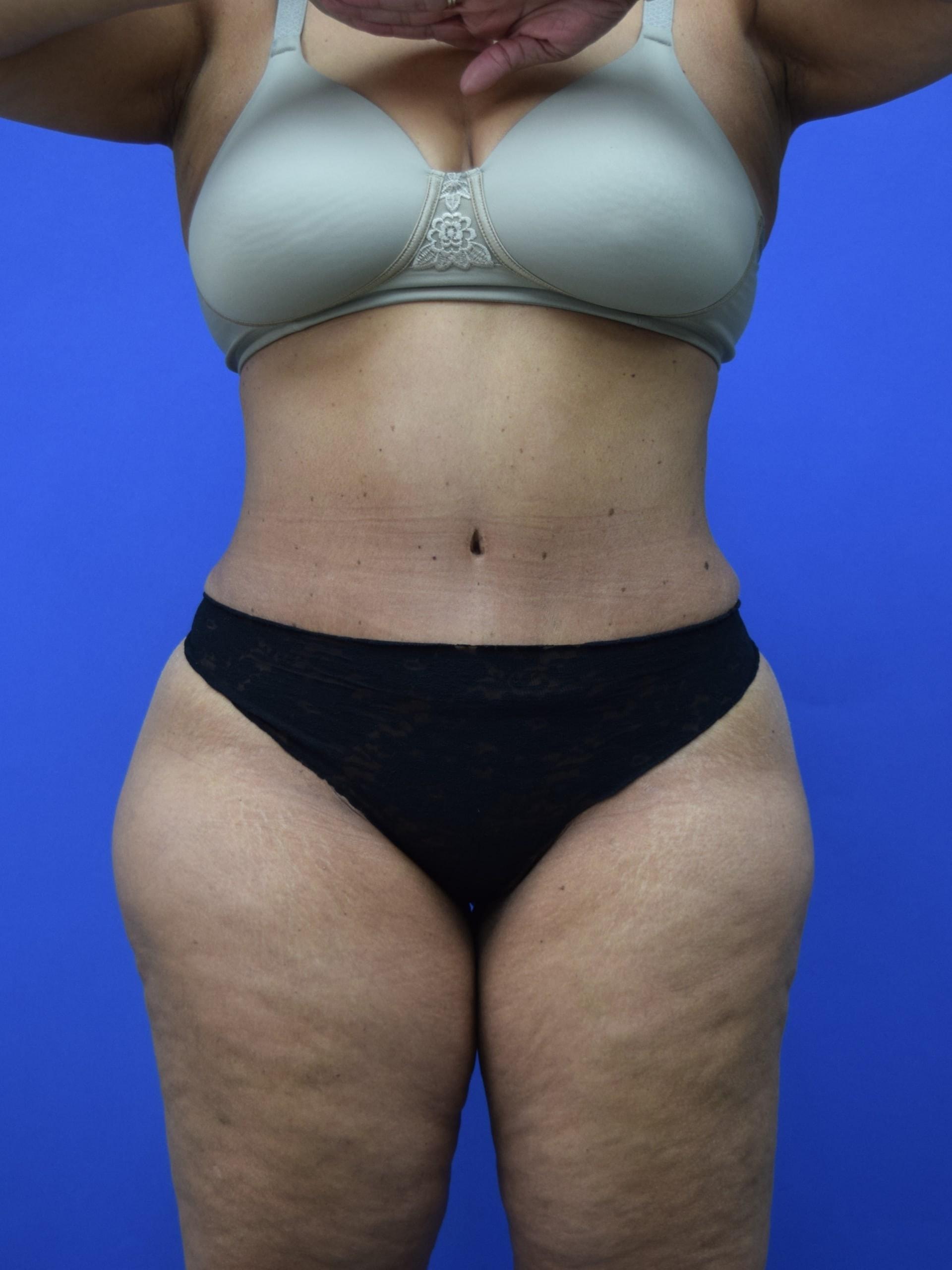 Glamour Plastic Surgery and Med Spa tummy tuck after — Bellaire, TX