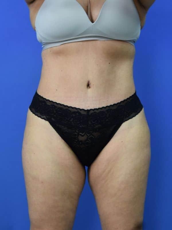 Glamour Plastic Surgery and Med Spa tummy tuck after — Bellaire, TX