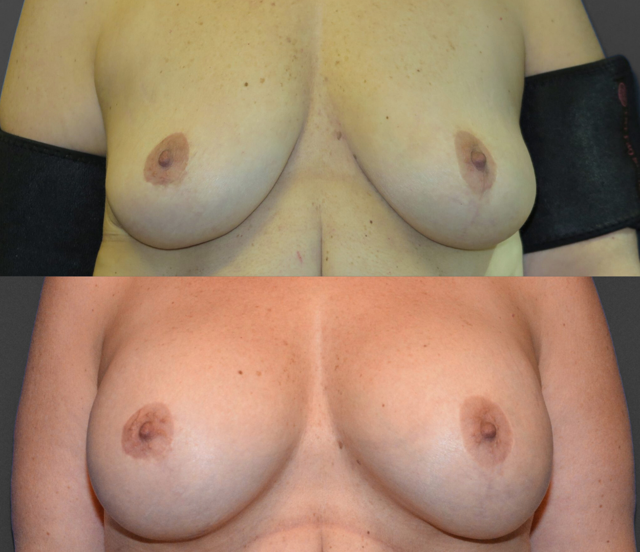 Breast Augmentation result at SoCal Plastic Surgeons | Dr. Matthew Nykiel in Newport Beach, CA