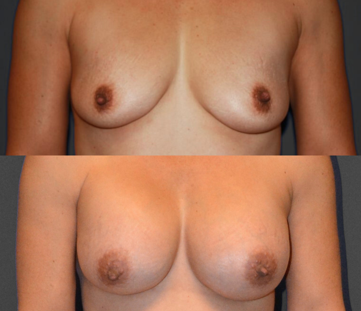 SoCal Plastic Surgeons | Dr. Matthew Nykiel breast augmentation result — Newport Beach, CA