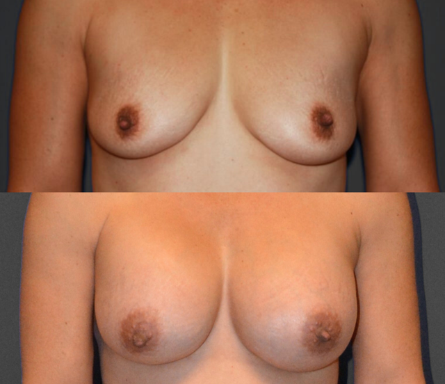 Breast Augmentation result at SoCal Plastic Surgeons | Dr. Matthew Nykiel in Newport Beach, CA