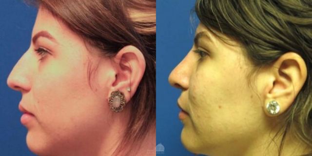 Rhinoplasty result at SoCal Plastic Surgeons | Dr. Matthew Nykiel in Newport Beach, CA