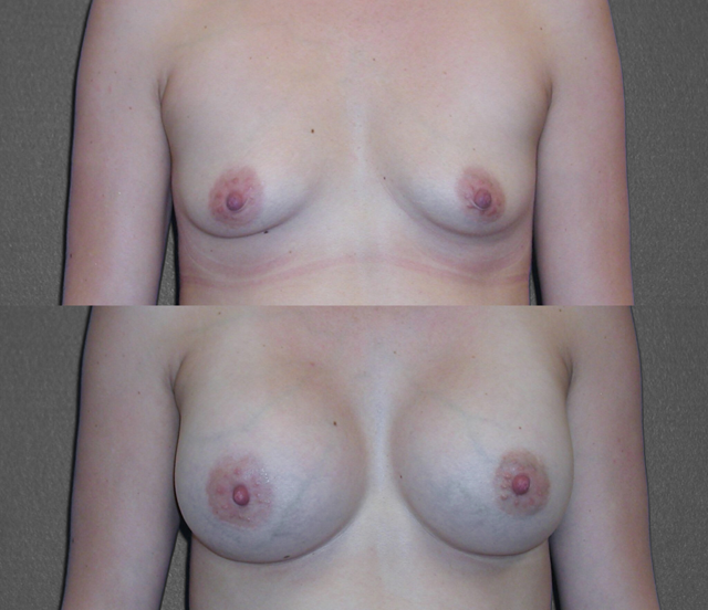 Breast Augmentation result at SoCal Plastic Surgeons | Dr. Matthew Nykiel in Newport Beach, CA