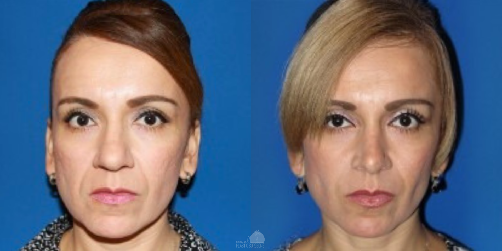 SoCal Plastic Surgeons | Dr. Matthew Nykiel rhinoplasty result — Newport Beach, CA