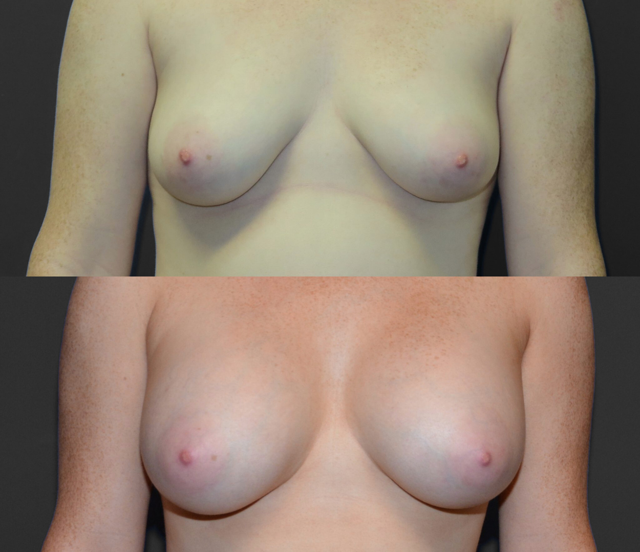 Breast Augmentation result at SoCal Plastic Surgeons | Dr. Matthew Nykiel in Newport Beach, CA