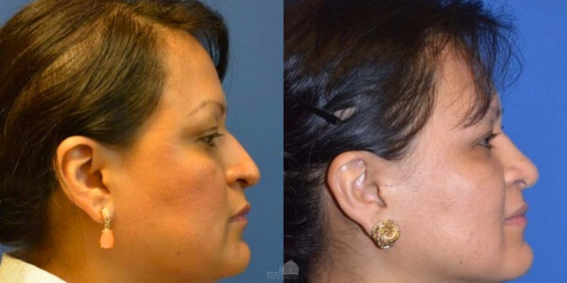 Rhinoplasty result at SoCal Plastic Surgeons | Dr. Matthew Nykiel in Newport Beach, CA
