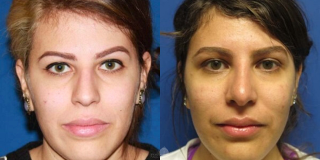 Rhinoplasty result at SoCal Plastic Surgeons | Dr. Matthew Nykiel in Newport Beach, CA