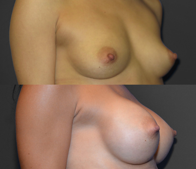 Breast Augmentation result at SoCal Plastic Surgeons | Dr. Matthew Nykiel in Newport Beach, CA