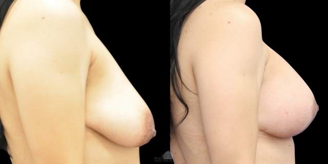 Breast Lift result at SoCal Plastic Surgeons | Dr. Matthew Nykiel in Newport Beach, CA