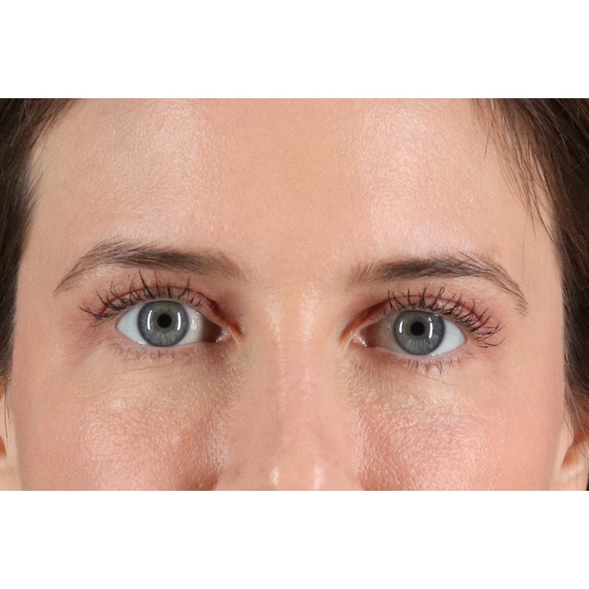 Berry Fairchild, MD eyelid lift after — Houston, TX