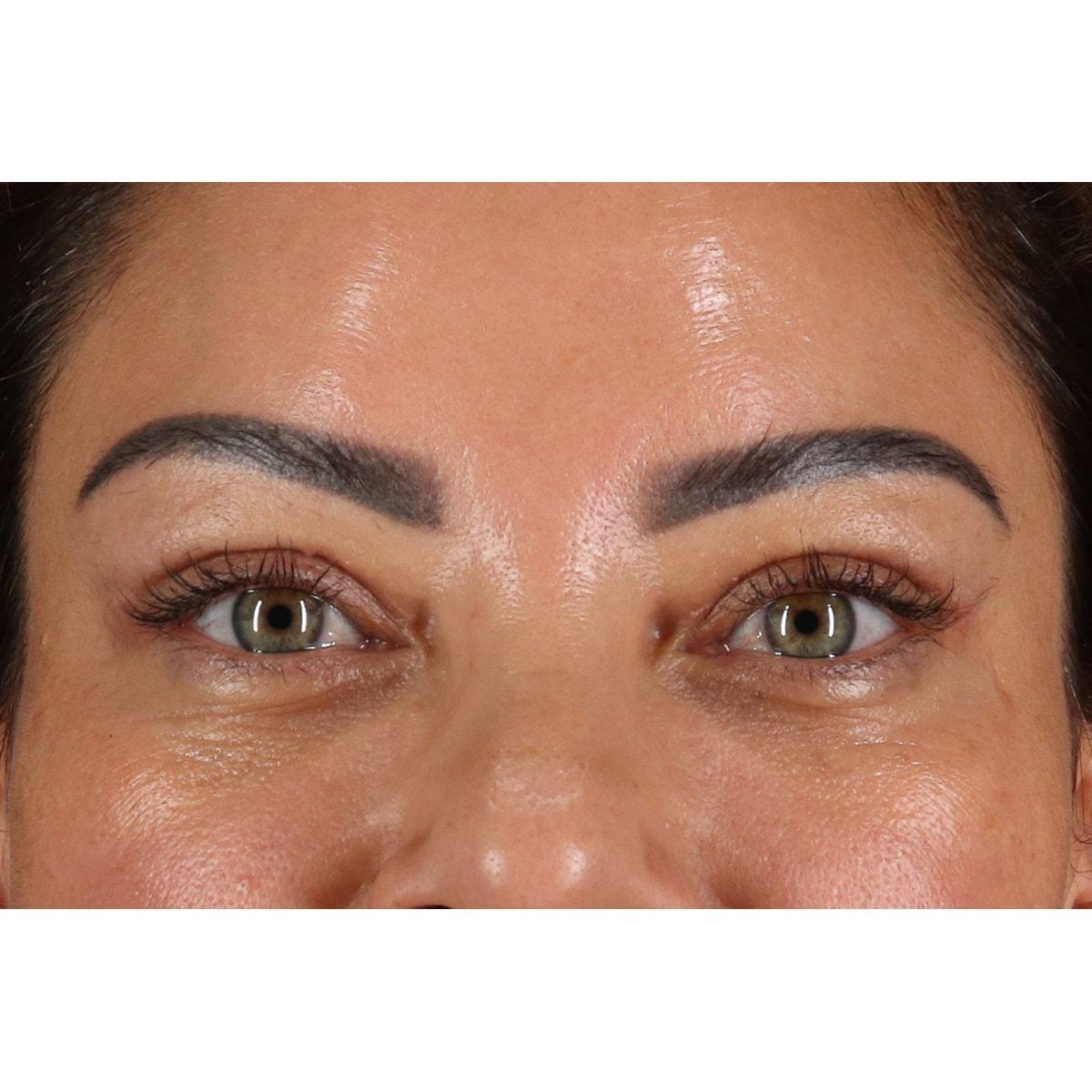 Berry Fairchild, MD eyelid lift after — Houston, TX