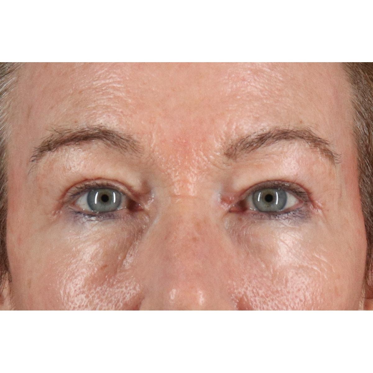 Berry Fairchild, MD eyelid lift after — Houston, TX
