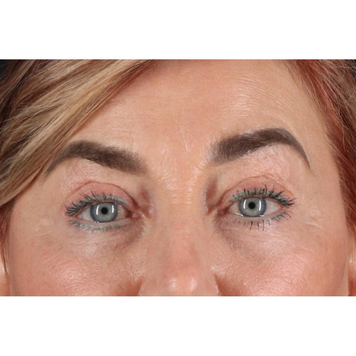 Berry Fairchild, MD eyelid lift after — Houston, TX