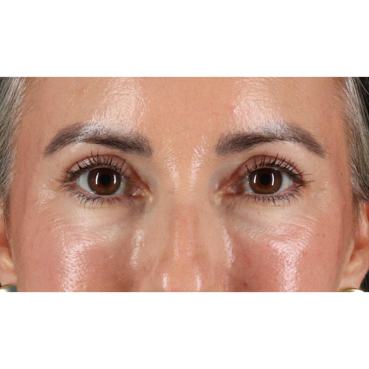 Berry Fairchild, MD eyelid lift after — Houston, TX