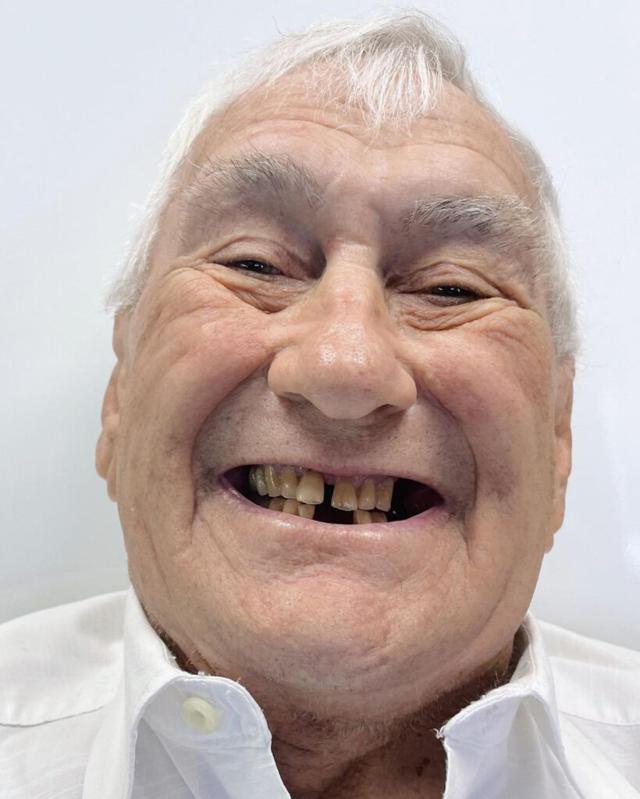 Smile Makeover before at Oceanview Dental in Oceanside, CA