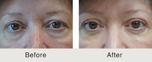 Blepharoplasty result at Carolina Facial Plastics in Charlotte, NC