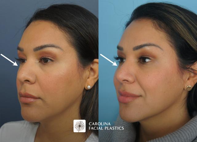 Rhinoplasty result at Carolina Facial Plastics in Charlotte, NC