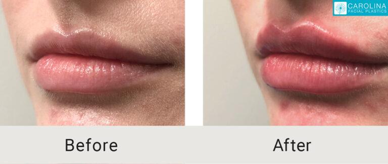 Carolina Facial Plastics lip filler result — Charlotte, NC