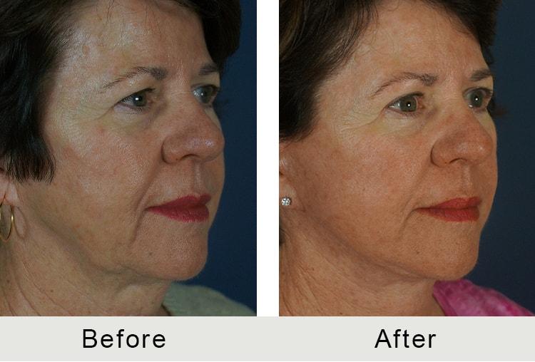 Carolina Facial Plastics neck lift result — Charlotte, NC