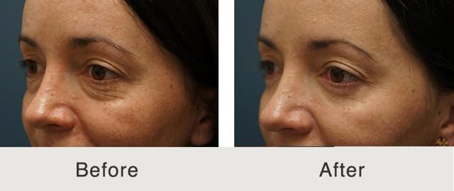 Blepharoplasty result at Carolina Facial Plastics in Charlotte, NC