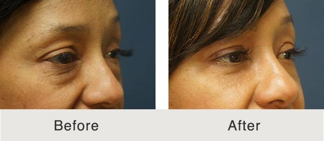 Blepharoplasty result at Carolina Facial Plastics in Charlotte, NC