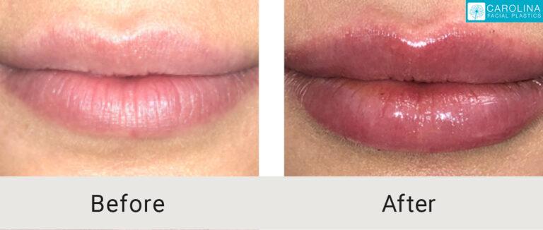 Carolina Facial Plastics lip filler result — Charlotte, NC