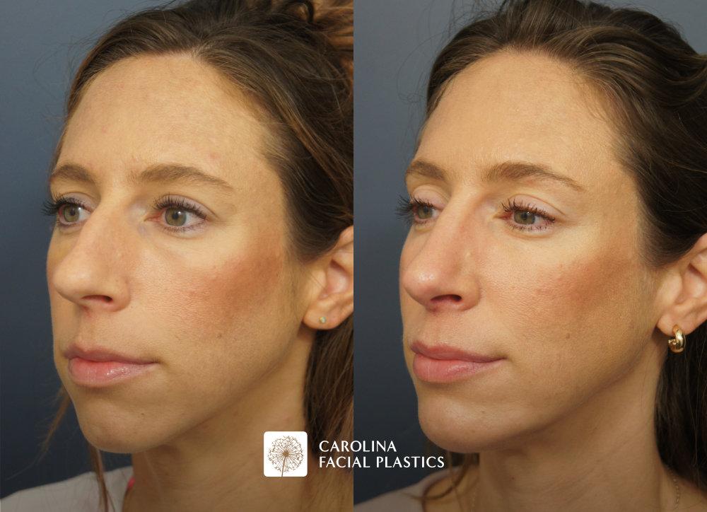 Carolina Facial Plastics rhinoplasty result — Charlotte, NC
