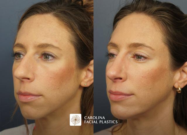 Rhinoplasty result at Carolina Facial Plastics in Charlotte, NC