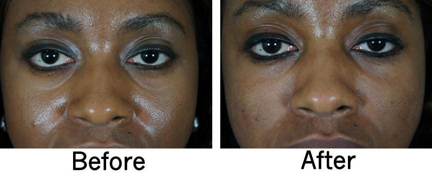 Carolina Facial Plastics under-eye filler result — Charlotte, NC